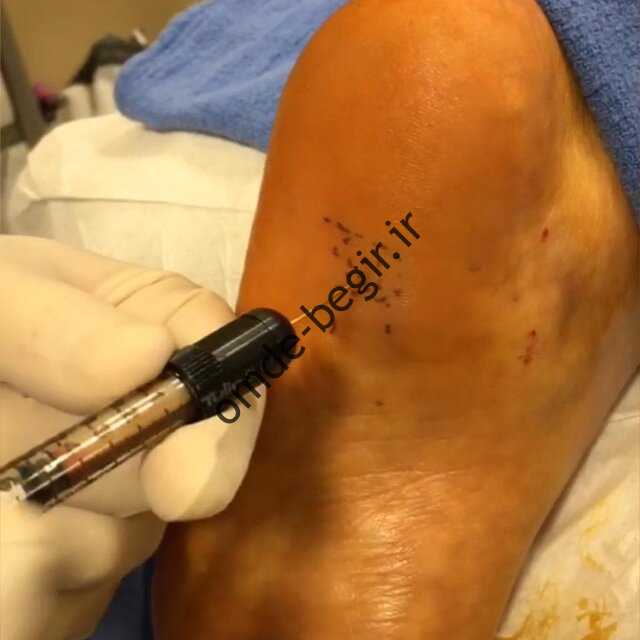 درمان درد پا با لیپوساکشن